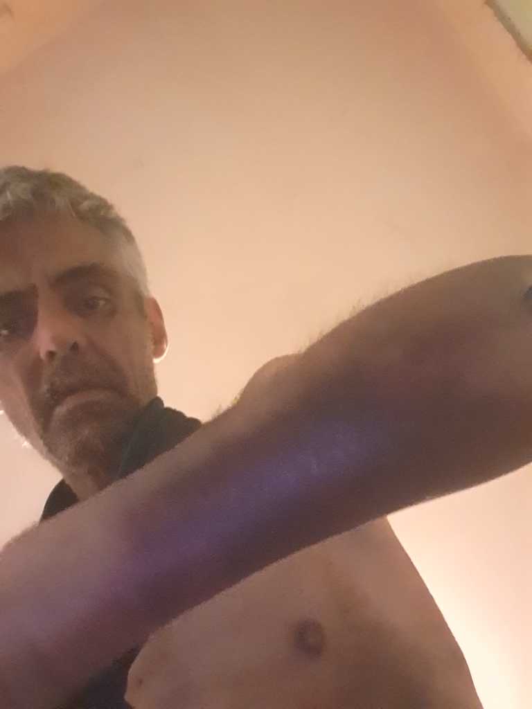 20220714 045233 scorched flesh arm 20220714 045233 scorched flesh arm